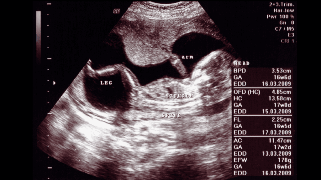 Actual USG report showing BPD, HC, AC, FL measurements with fetal anatomy labeled