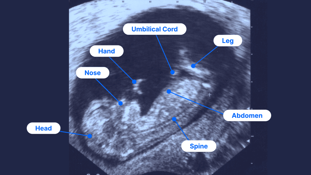 Labeled obstetric ultrasound showing fetal anatomy